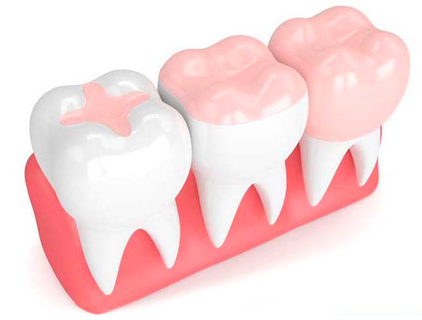 Tipos de restauração de dente