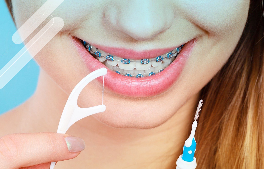 Dificuldade de Usar o Tradicional Fio Dental para Aparelho Fixo