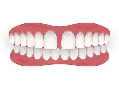 Aparelho Ortodôntico - Diastema