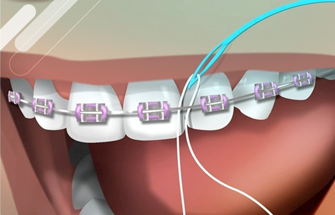 Qual Fio Dental é Ideal para Quem Usa Aparelho